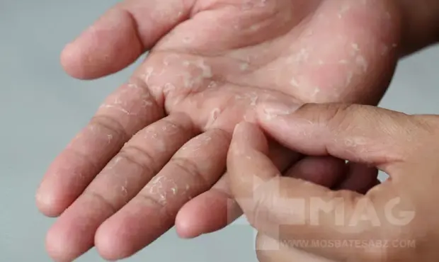 علت پوست پوست شدن کف دست چیست ؟ چه باید کرد ؟